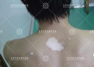 遮盖腿部瑕疵的化妆法